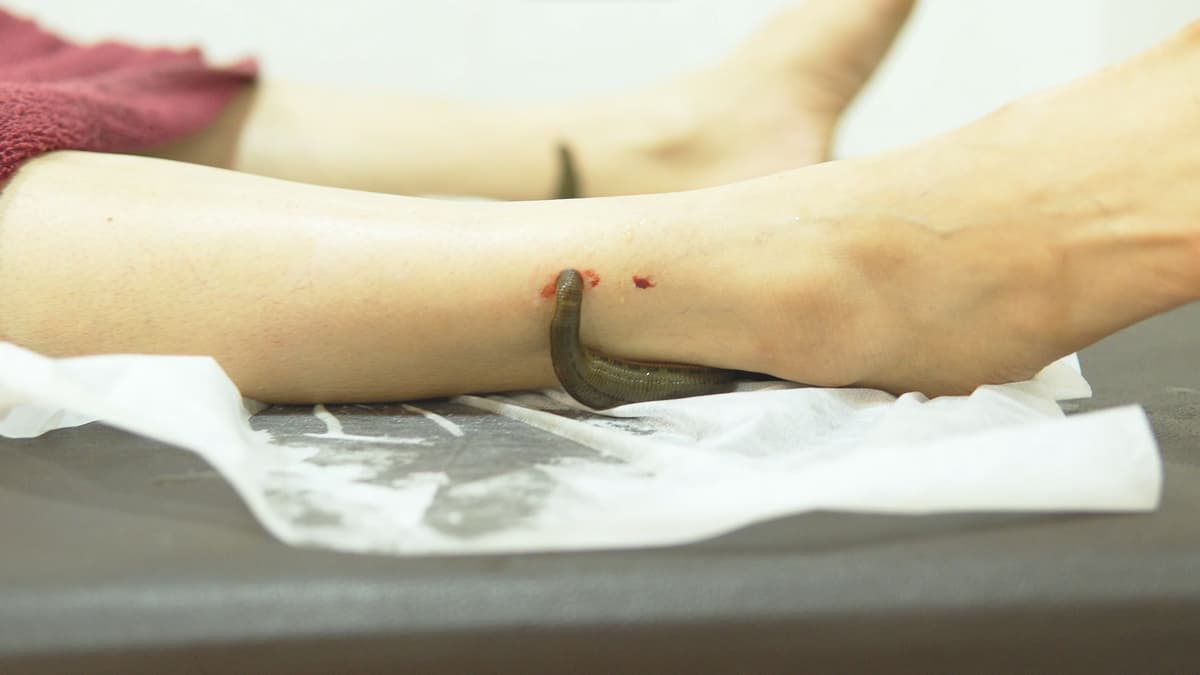 Leech Therapy