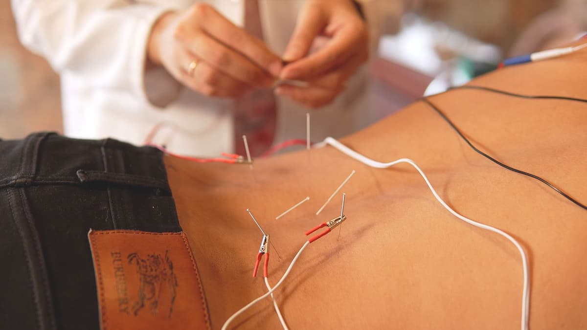 Electro Acupuncture