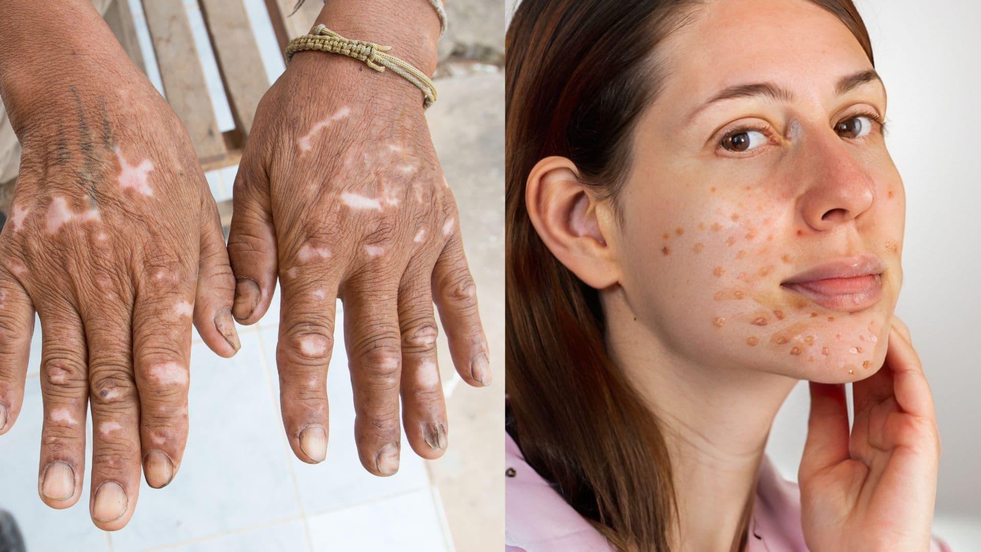 Skin Disorders