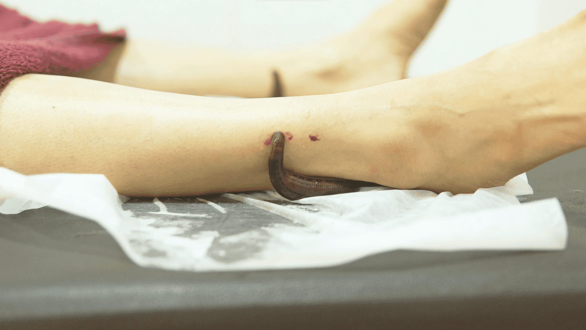 Beginner's Guide To Leech Therapy: Benefits And Techniques