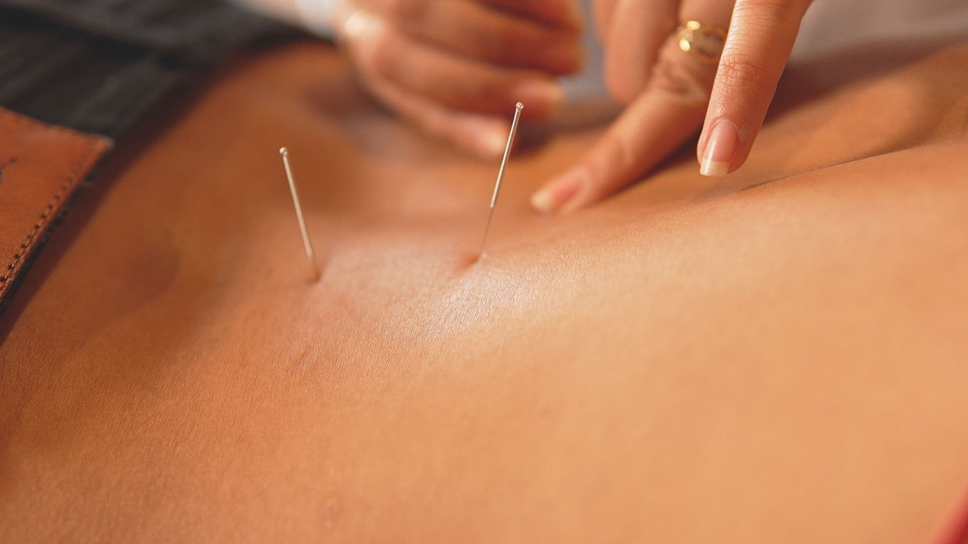 acupuncture