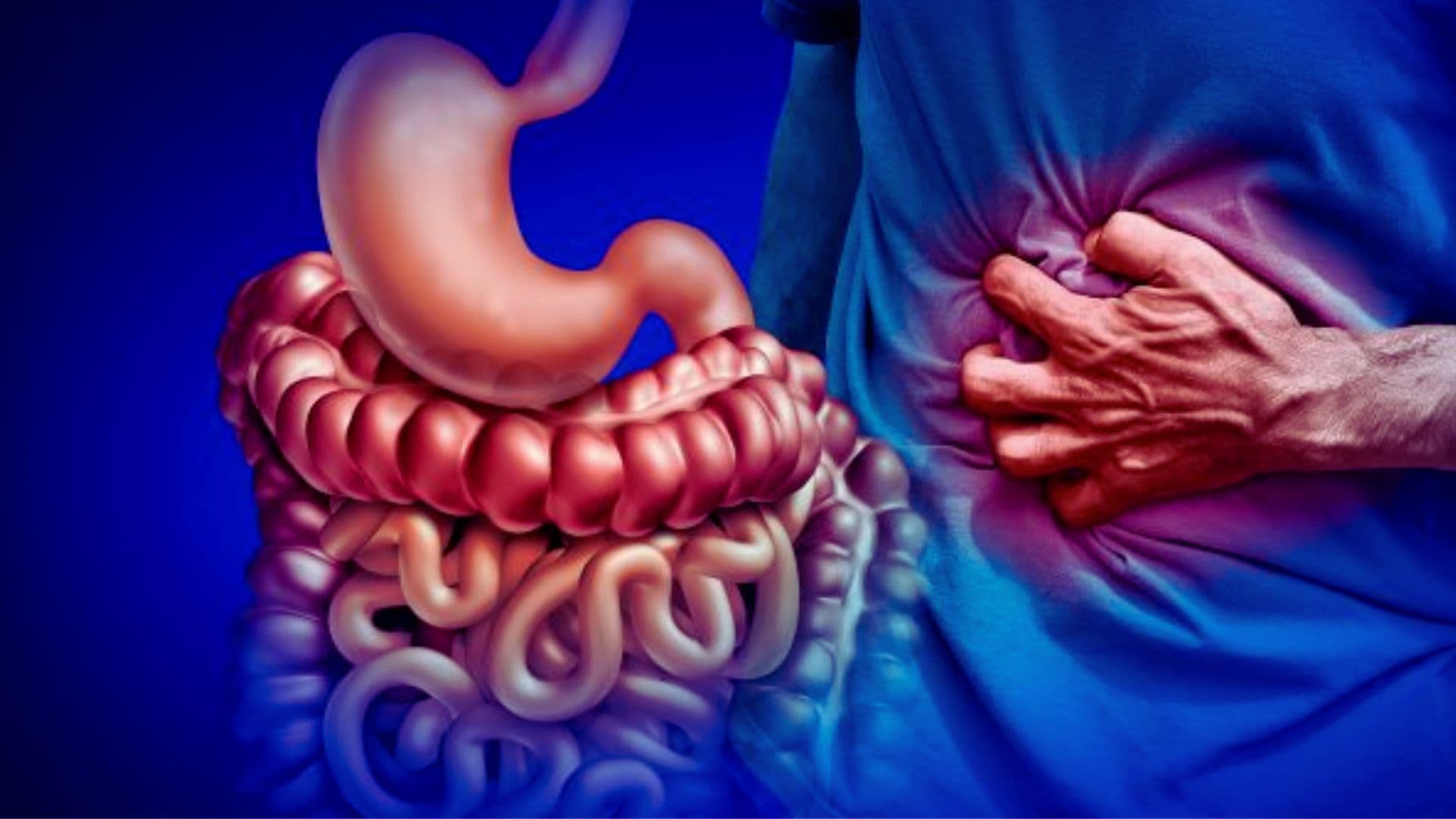 Ulcerative colitis (UC)