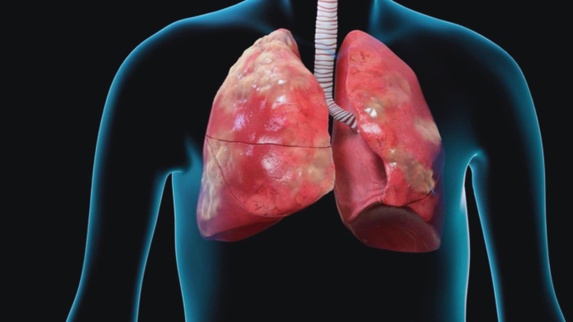 Chronic obstructive pulmonary disease (COPD)
