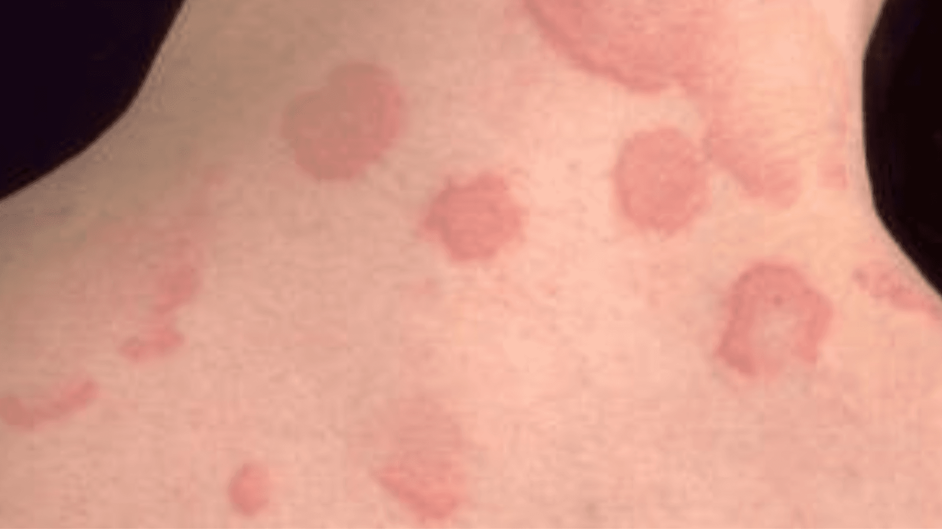Urticaria Hives