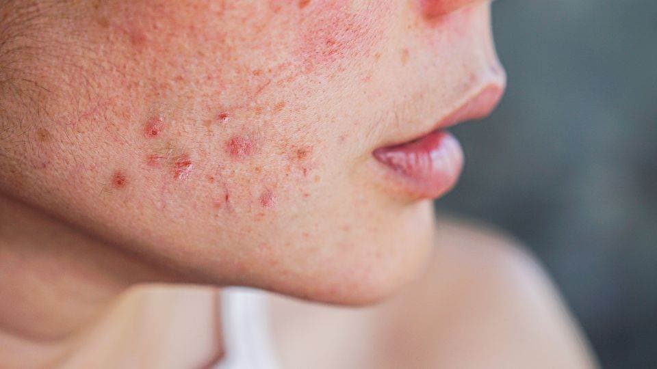 How To Get Rid of Acne Naturally?