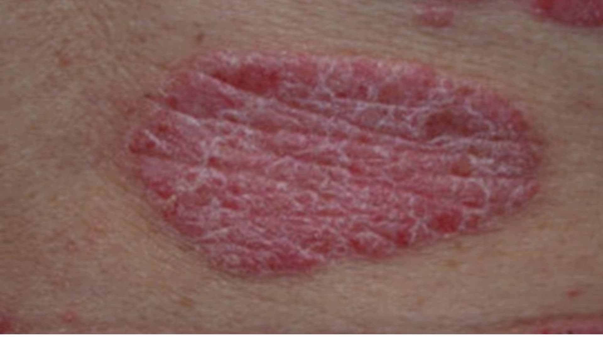 psoriasis