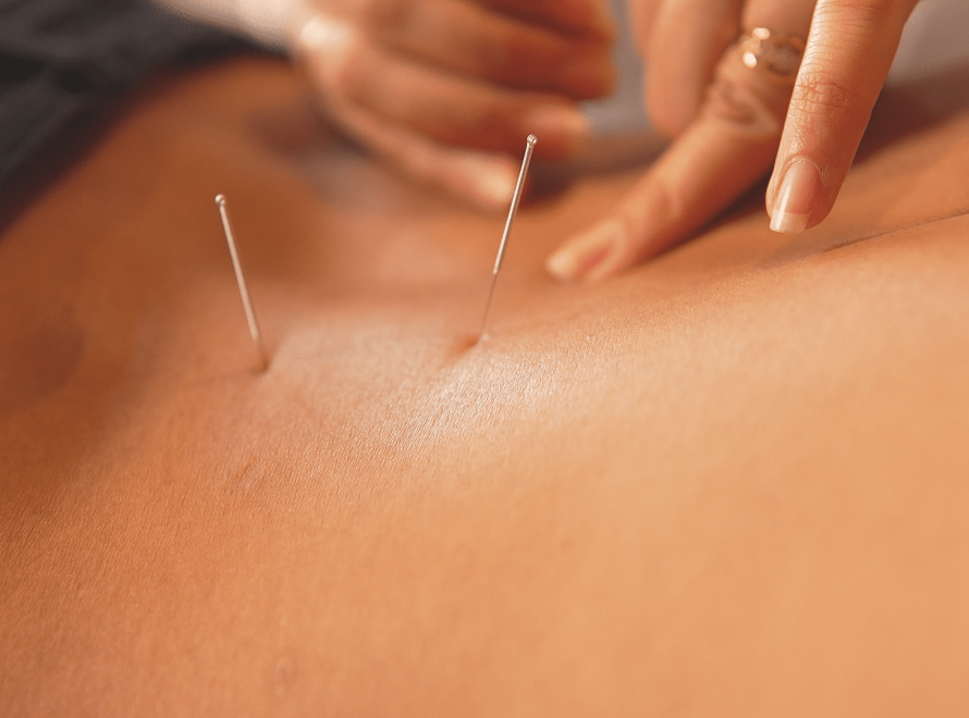 Acupuncture Therapy